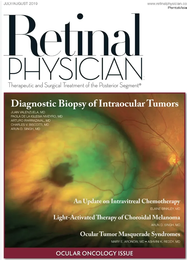 Tapa de Retinal Physician, julio/agosto de 2019: nota de tapa Diagnostic Biopsy of Intraocular Tumors, de Juan Valenzuela y coautores
